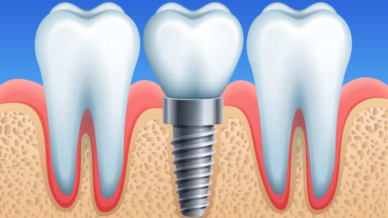 dental implant brisbane
