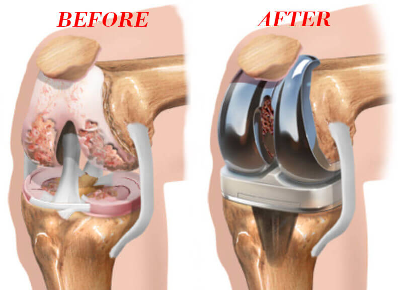 Knee replacement Perth.