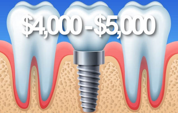 Price dental implants Perth.
